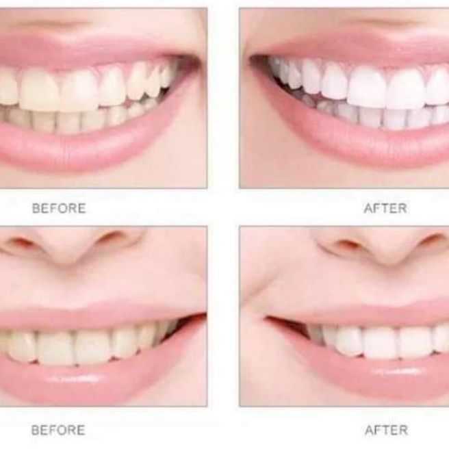 🔥 Xpert Teeth Whitening Drops – 7 Din Mein Chamakte Safed Daant, Ghar Baithe!