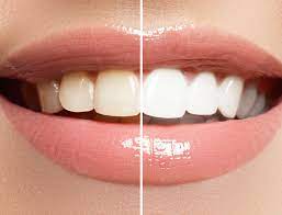 🔥 Xpert Teeth Whitening Drops – 7 Din Mein Chamakte Safed Daant, Ghar Baithe!